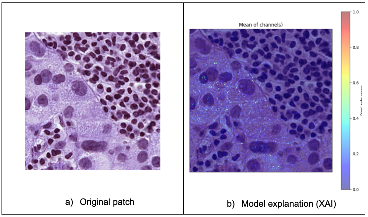 GradCAM explanation of the tumor patch-base prediction